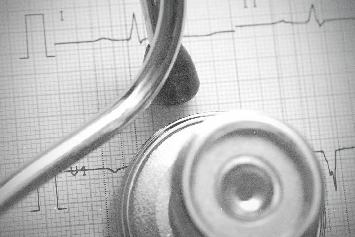 A stethoscope resting on medical chart paper displaying heart rhythm lines